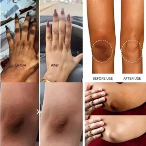 Whitening Cream Private Parts Underarm Bleaching Serum Whiten Butt Knee Brighten Inner Thigh Intimate Parts Dark Remove Melanin - Image 2
