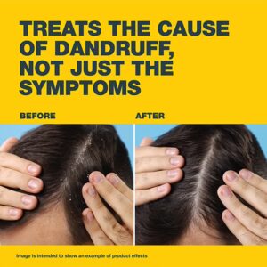 Nizoral Anti-Dandruff Treatment Shampoo, 100 Ml, Effective Dandruff Treatment, Works From The First Wash, Clinically Proven Ketoconazole Shampoo To Relieve Itchy Scalp 100ml - Image 8