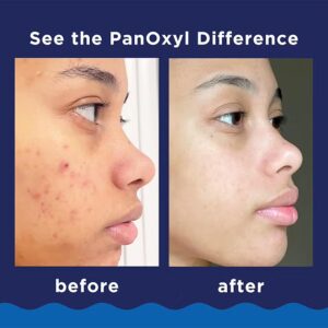 PanOxyl Pack of 1 Acne Foaming Wash, Peroxide 10% Maximum Strength Packaging May Vary 5.5ounce - Image 2